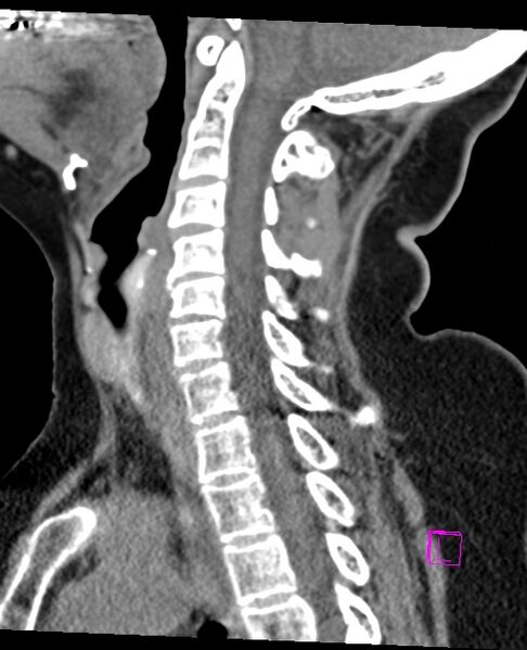 File:Bilateral atlanto-occipital assimilation (Radiopaedia 28350-28603 D 38).jpg