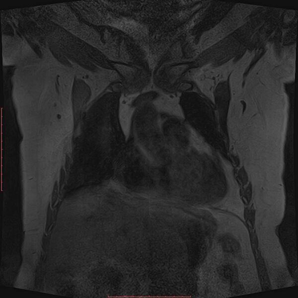 File:Bilateral breast implant rupture (Radiopaedia 24761-25027 G 3).jpg