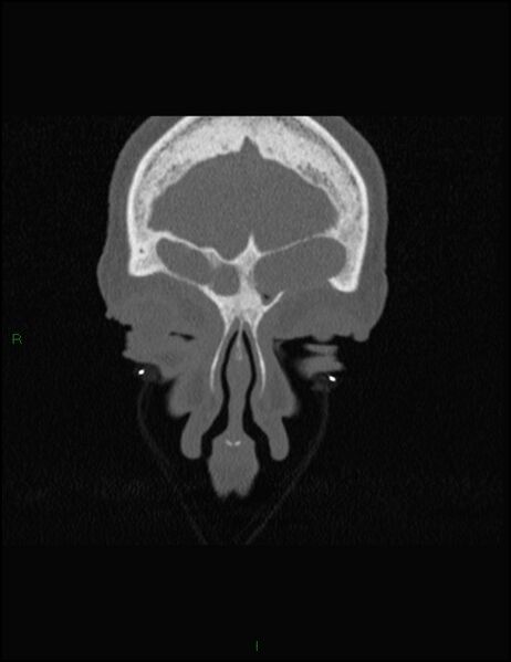File:Bilateral frontal mucoceles (Radiopaedia 82352-96454 Coronal 61).jpg