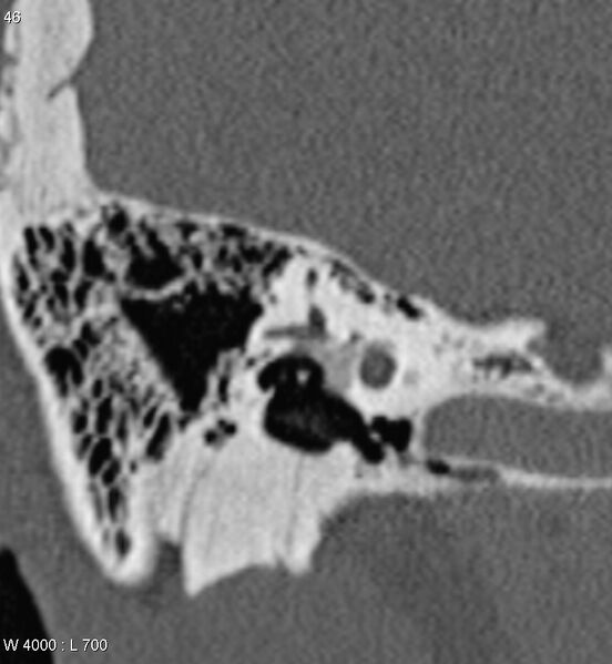 File:Bilateral otosclerosis with left stapes prosthesis (Radiopaedia 5567-7302 Coronal bone window 3).jpg