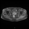 Bilateral ovarian fibroma (Radiopaedia 44568-48293 Axial T1 fat sat 21).jpg
