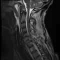 Bilateral perched facets with cord injury (Radiopaedia 45587-49714 Sagittal T2 9).jpg