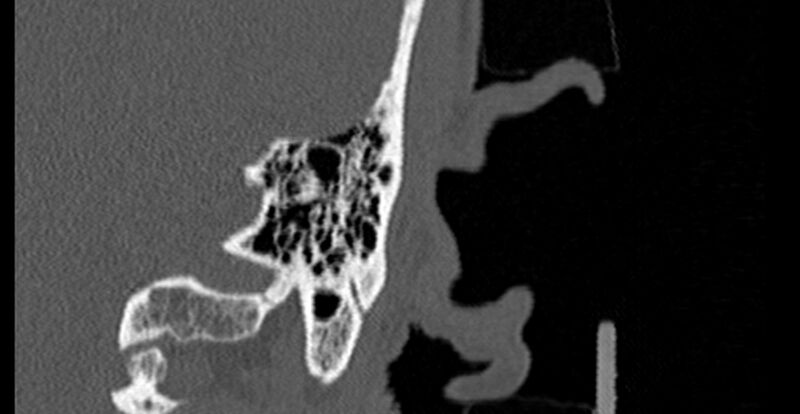 File:Bilateral temporal bone fractures (Radiopaedia 29482-29970 B 81).jpg