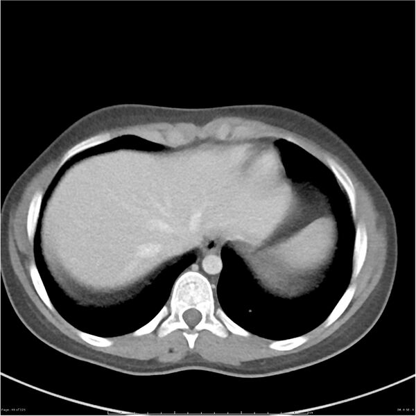 File:Bilateral ureteritis and cystitis (Radiopaedia 25340-25594 A 6).jpg