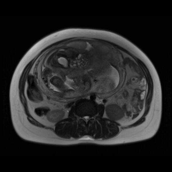 File:Bilobed placenta accreta (Radiopaedia 69648-79591 Axial T2 16).jpg