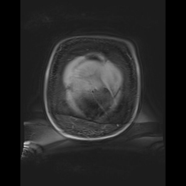 File:Bilobed placenta accreta (Radiopaedia 69648-79591 Coronal T1 vibe 12).jpg