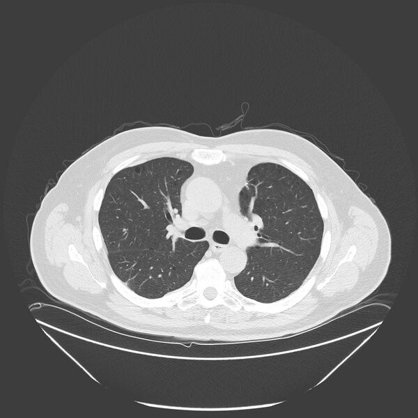 File:Birt-Hogg-Dubé syndrome (Radiopaedia 52578-58491 Axial lung window 24).jpg