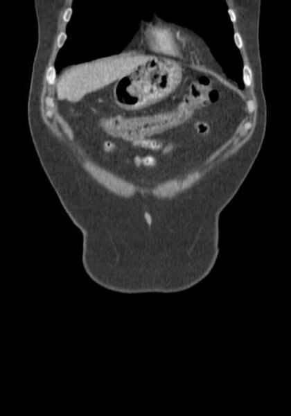 File:Bleeding duodenal ulcer and adenomyomatosis of gallbladder (Radiopaedia 61834-69861 B 76).jpg