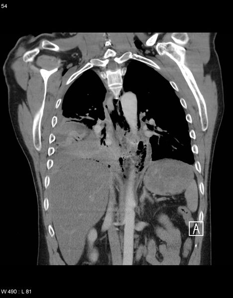 File:Boerhaave syndrome with tension pneumothorax (Radiopaedia 56794-63605 B 22).jpg