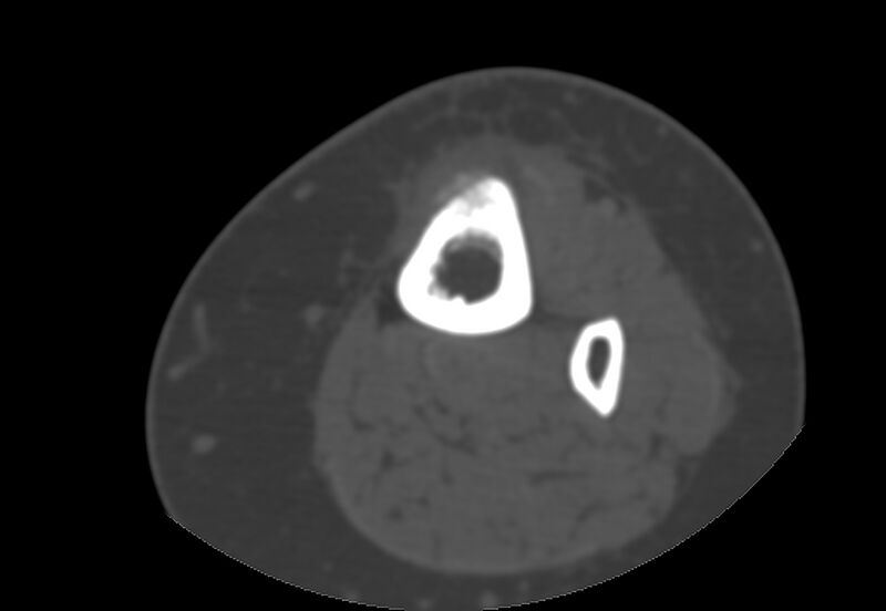 File:Bone metastasis - tibia (Radiopaedia 57665-64609 Axial bone window 25).jpg
