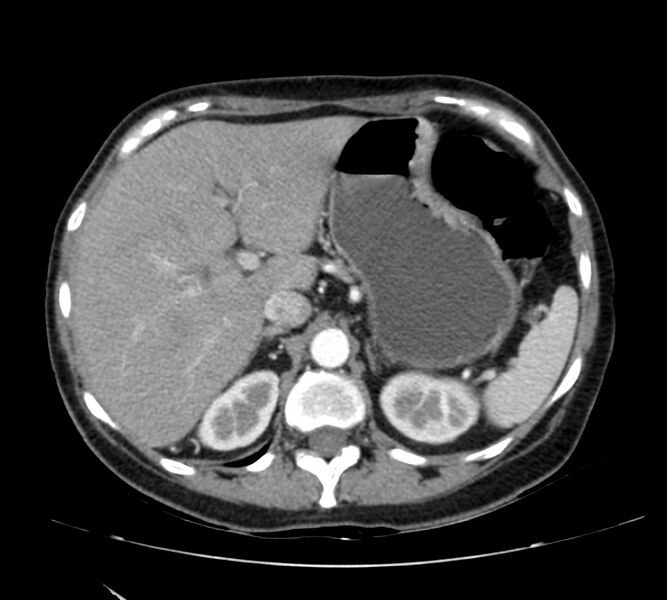File:Bosniak renal cyst - type IV (Radiopaedia 22929-22953 B 23).jpg