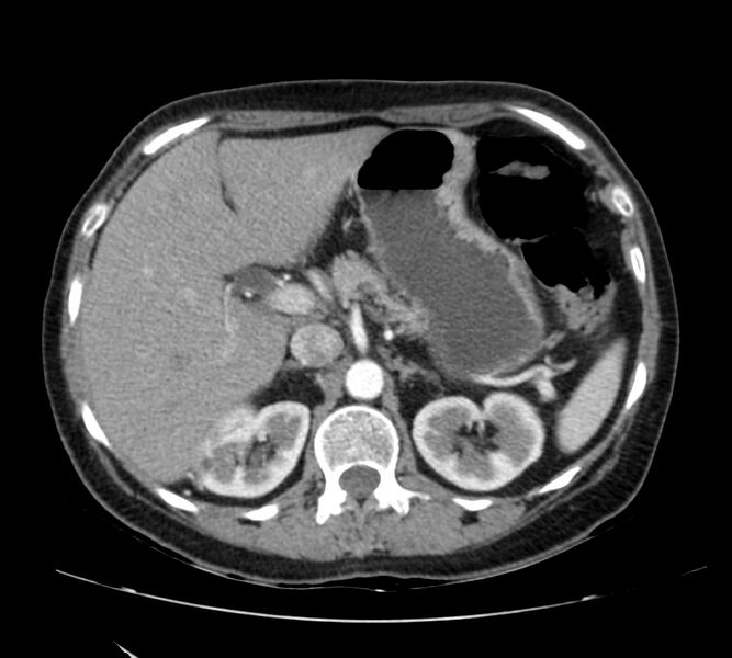 File:Bosniak renal cyst - type IV (Radiopaedia 22929-22953 B 27).jpg