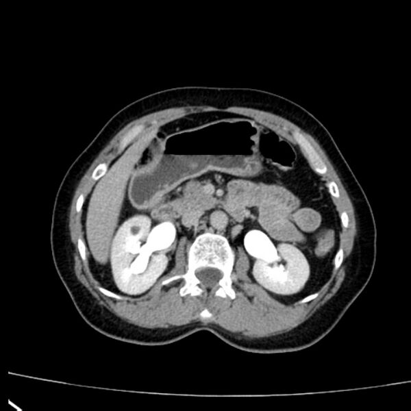 File:Bosniak renal cyst - type I (Radiopaedia 27479-27675 D 16).jpg