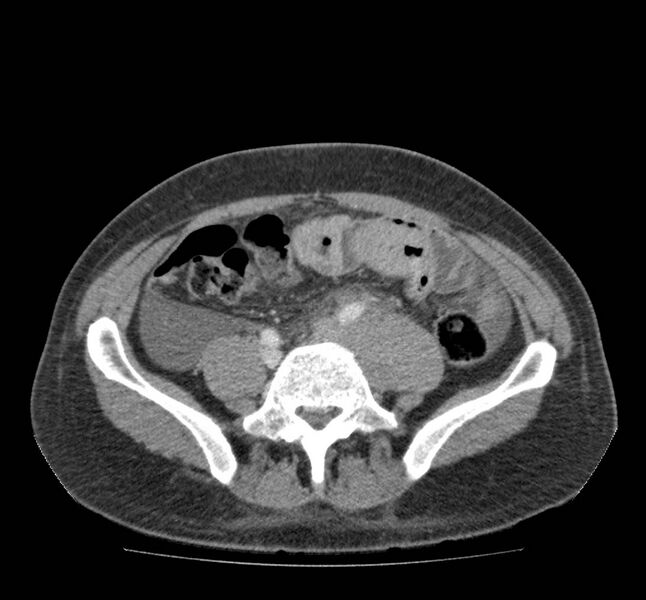 File:Bowel lymphoma complicated by bleeding after therapy (Radiopaedia 55601-62107 A 56).jpg