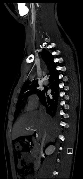 File:Brachiocephalic trunk pseudoaneurysm (Radiopaedia 70978-81191 C 38).jpg