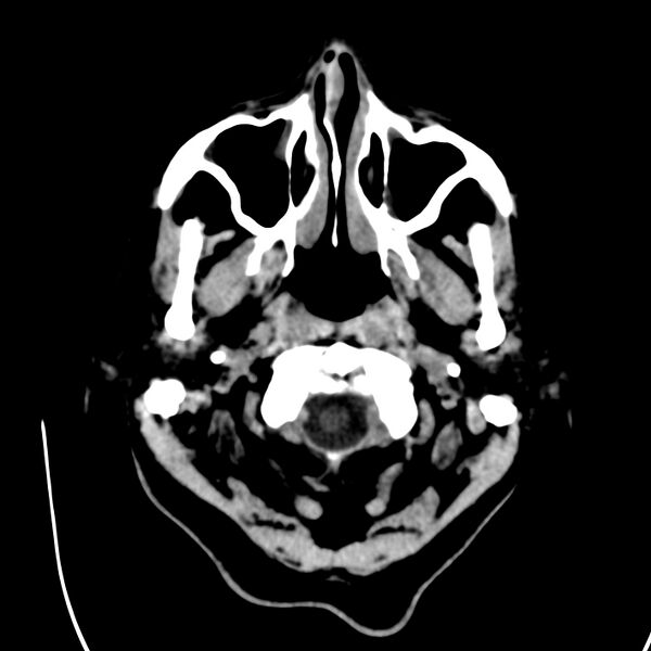 File:Brain Pantopaque remnants (Radiopaedia 78403-91048 Axial non-contrast 13).jpg