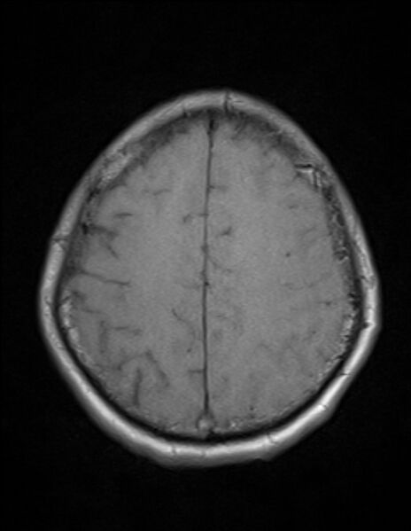 File:Brain abscess with ventriculitis (Radiopaedia 85703-101495 Axial T1 21).jpg
