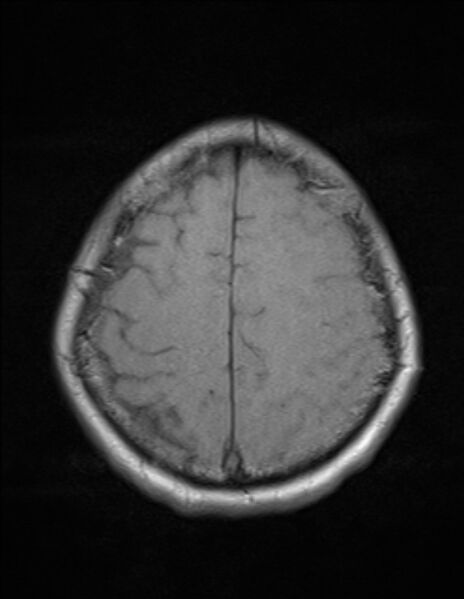 File:Brain abscess with ventriculitis (Radiopaedia 85703-101495 Axial T1 22).jpg