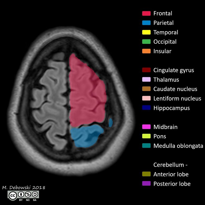 Brain lobes - annotated MRI (Radiopaedia 61691-69700 Axial 7).JPG