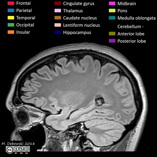 File:Brain lobes - annotated MRI (Radiopaedia 61691-69700 Sagittal 23).JPG