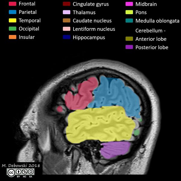 File:Brain lobes - annotated MRI (Radiopaedia 61691-69700 Sagittal 70).JPG