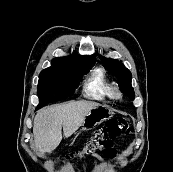 File:Brain metastases - lung cancer primary (Radiopaedia 75060-86116 C+ arterial phase 7).jpg