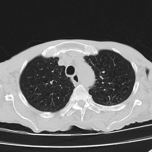 File:Brain metastases from lung cancer (Radiopaedia 27849-28093 Axial lung window 15).jpg