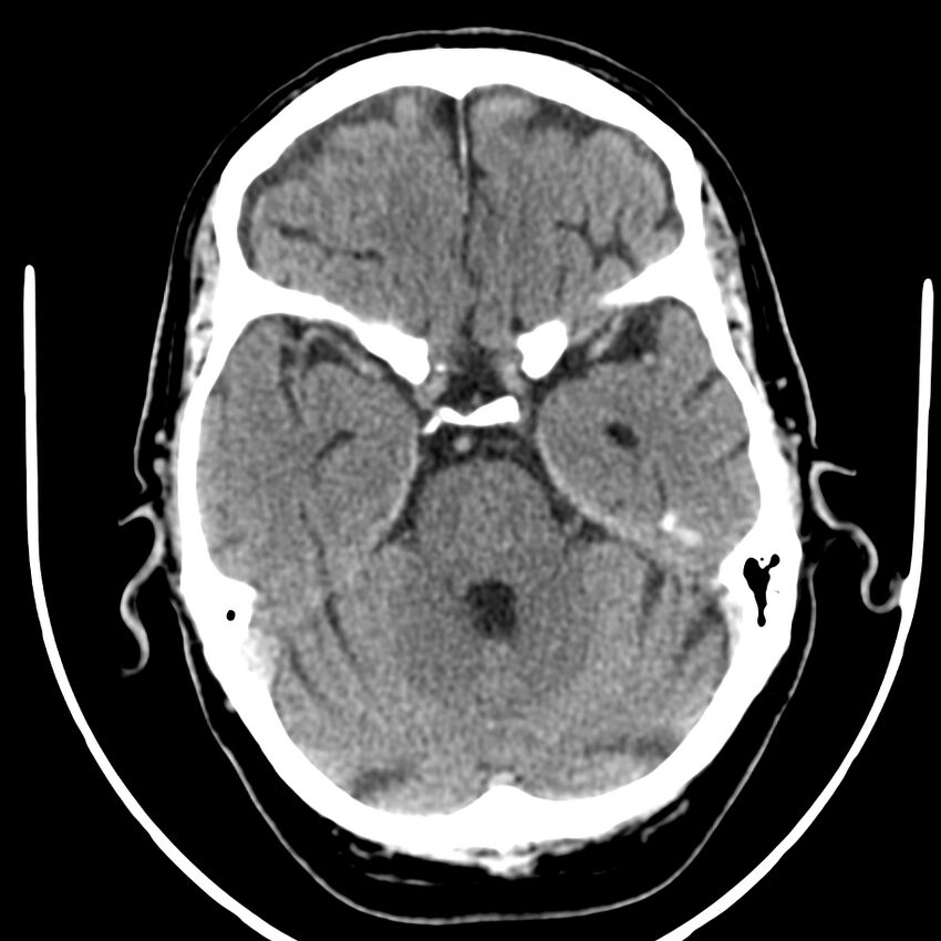 Brain metastasis (Radiopaedia 42617-45760 Axial non-contrast 13).jpg