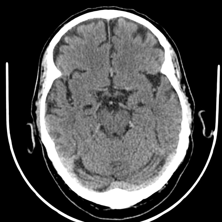 Brain metastasis (Radiopaedia 42617-45760 Axial non-contrast 16).jpg