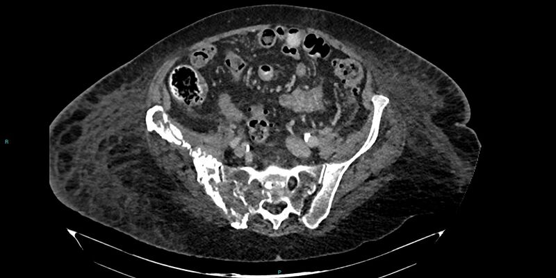 File:Breast cancer pelvic bony metastases (Radiopaedia 84470-99824 Axial bone window 30).jpg