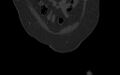 Breast carcinoma with pathological hip fracture (Radiopaedia 60314-67993 Coronal bone window 31).jpg