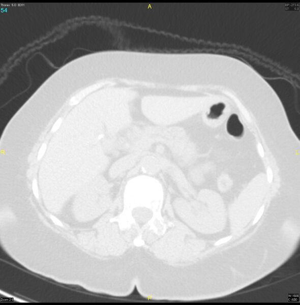 File:Breast primary with lung and bone metastases (Radiopaedia 40620-43228 Axial lung window 54).jpg