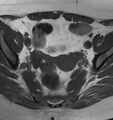 Broad ligament leiomyoma (Radiopaedia 81634-95516 Axial T1 10).jpg