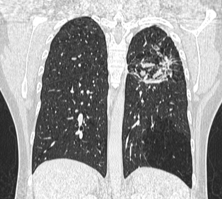 Bronchial atresia (Radiopaedia 50007-55297 Coronal lung window 79).jpg