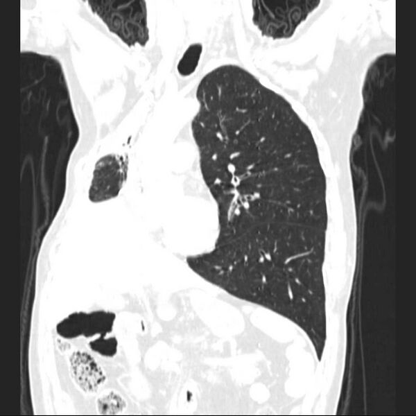 File:Bronchopleural fistula - postoperative complication (Radiopaedia 21020-20947 Coronal lung window 12).jpg