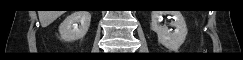 File:Buried bumper syndrome - gastrostomy tube (Radiopaedia 63843-72575 Coronal Inject 68).jpg