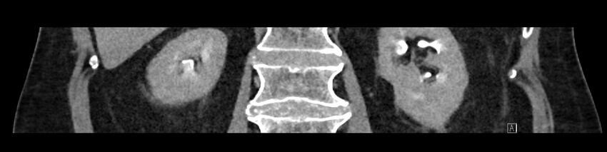 Buried bumper syndrome - gastrostomy tube (Radiopaedia 63843-72575 Coronal Inject 68).jpg