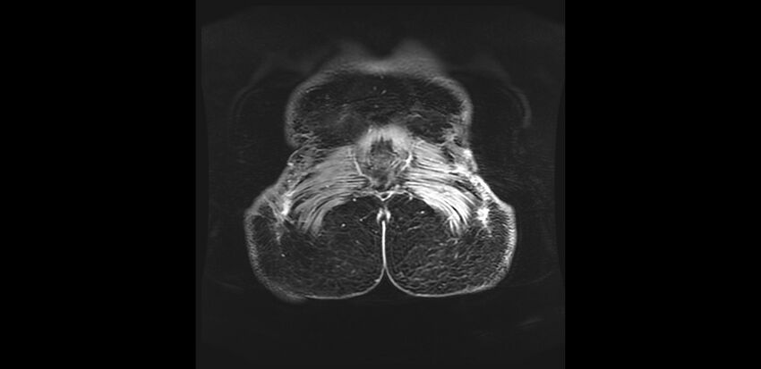 Buttock filler complications (Radiopaedia 63497-72115 Coronal T1 C+ 58).jpg