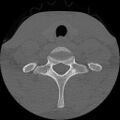 C5 facet fracture (Radiopaedia 58374-65499 Axial bone window 78).jpg