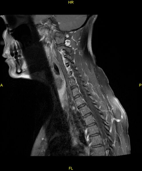 File:C5 nerve sheath tumor (Radiopaedia 85777-101596 F 8).jpg