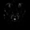 CNS lymphoma (Radiopaedia 73088-83796 Axial DWI 1).jpeg