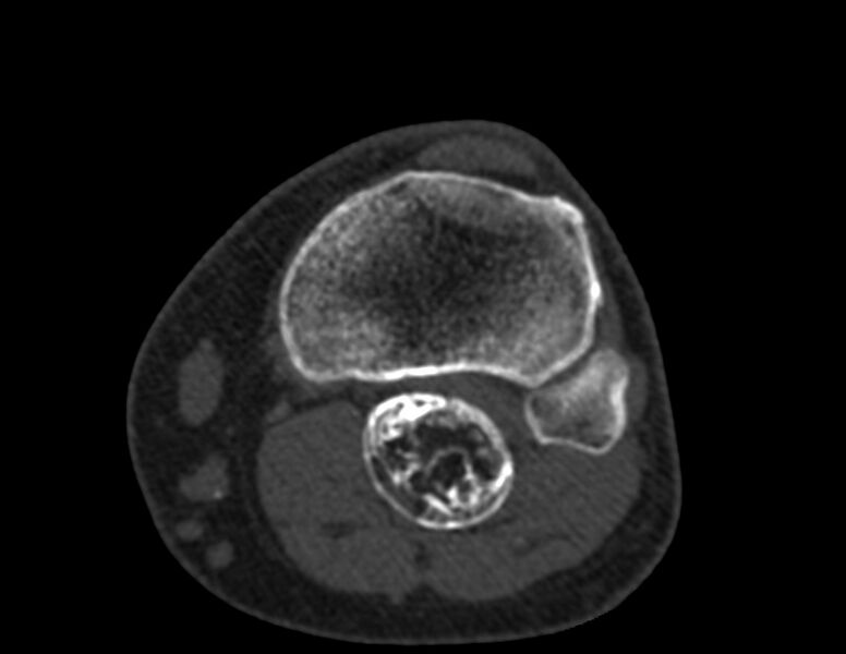 File:Calcified hematoma - popliteal fossa (Radiopaedia 63938-72763 Axial bone window 61).jpg