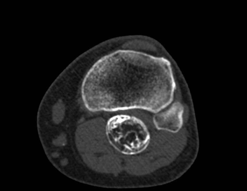 Calcified hematoma - popliteal fossa (Radiopaedia 63938-72763 Axial bone window 61).jpg