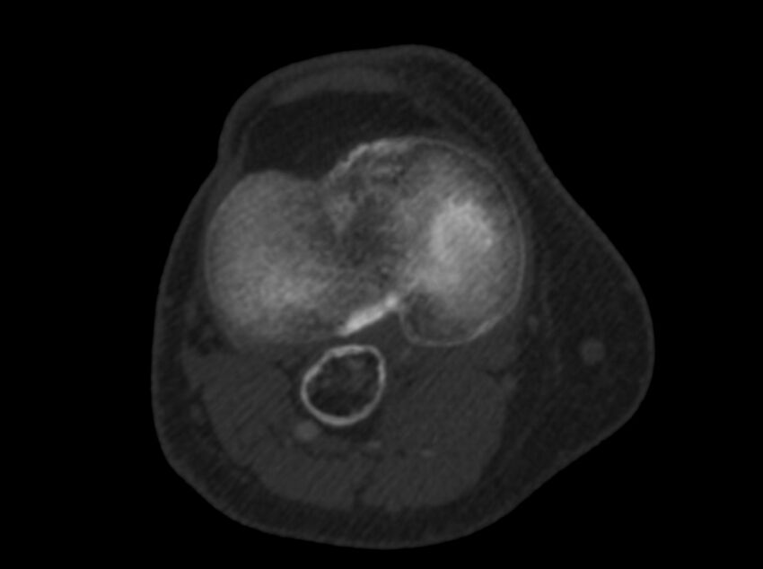 Calcified hematoma - popliteal fossa (Radiopaedia 63938-72763 C 33).jpg