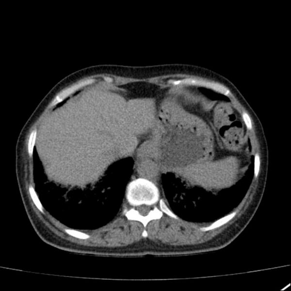 File:Calcified hepatic hydatid cyst (Radiopaedia 26872-27046 Axial non-contrast 15).jpg