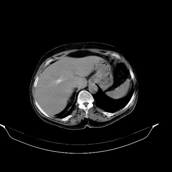 File:Calcified hydatid cyst (Radiopaedia 62000-70085 Axial non-contrast 28).jpg
