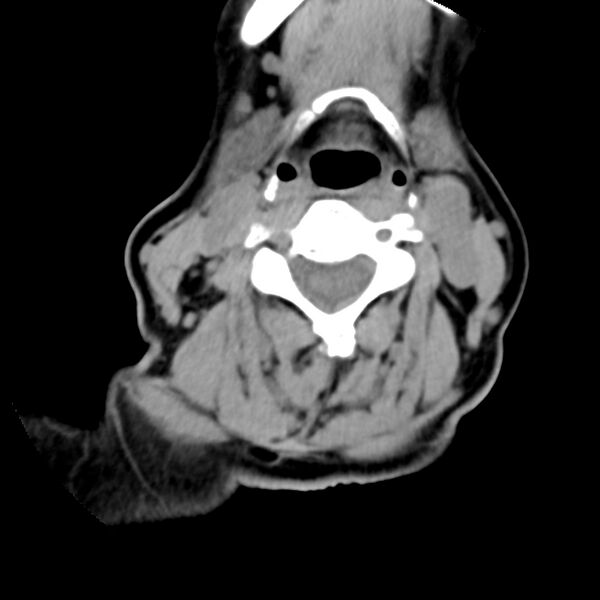 File:Calcified meningioma - cervical canal (Radiopaedia 70136-80171 B 18).jpg