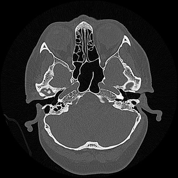 File:Canal up mastoidectomy (Radiopaedia 78108-90638 Axial bone window 57).jpg