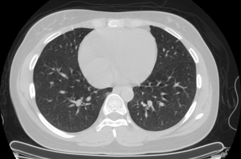 File:Cannonball metastases - uterine choriocarcinoma (Radiopaedia 70137-80173 Axial lung window 74).jpg