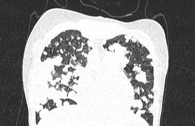 File:Cannonball metastases from breast cancer (Radiopaedia 91024-108569 Coronal lung window 43).jpg